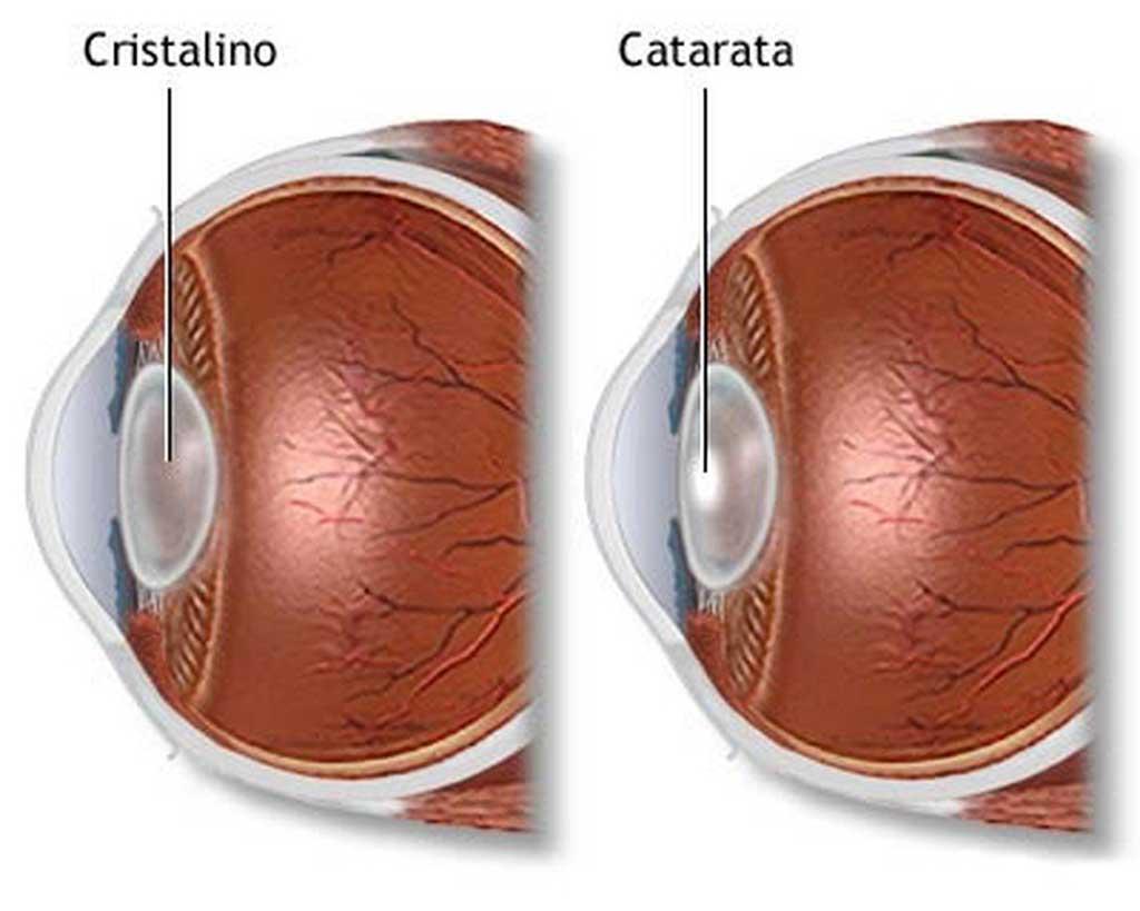 Catarata: doença com cura ainda tira qualidade de vida de idosos